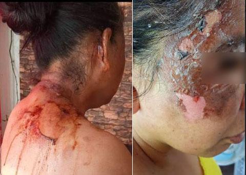 Queman con agua hirviendo a mujer en restaurante de Izúcar image 2