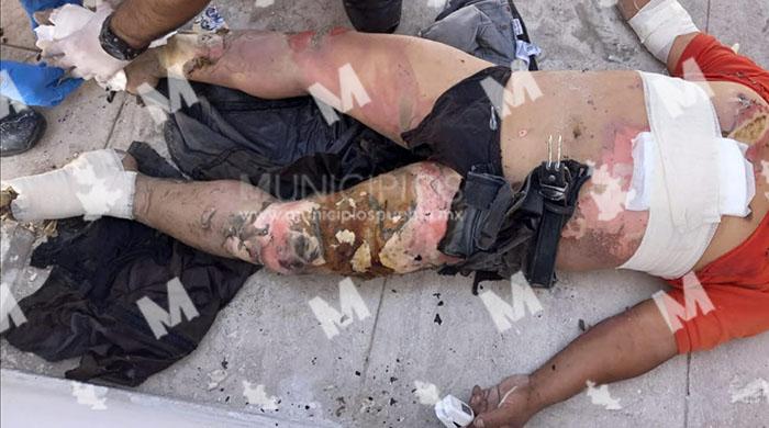 Albañil se electrocuta y sufre quemaduras de tercer grado en Atlixco image 2