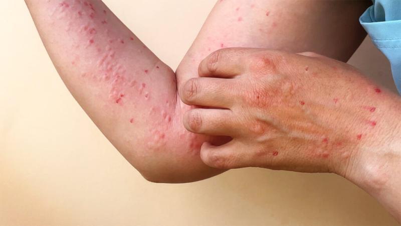 Reportan en Sonora dos casos importados de Mpox