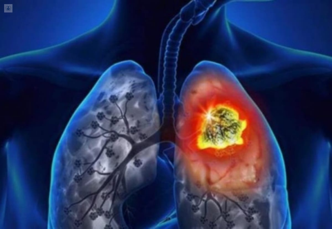 Cáncer de pulmón, séptimo lugar con más casos en el país
