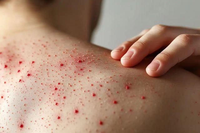 México enfrenta brote de sarampión; 21 contagios registrados en dos estados