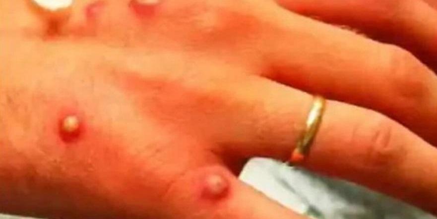 Cuba registra muerte de turista con viruela del mono