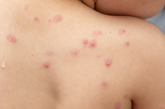 Desciende Puebla al séptimo sitio en contagios de viruela del mono