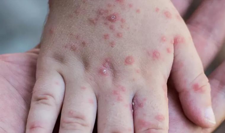 Por brote de virus coxsackie cierran primaria en Oaxaca