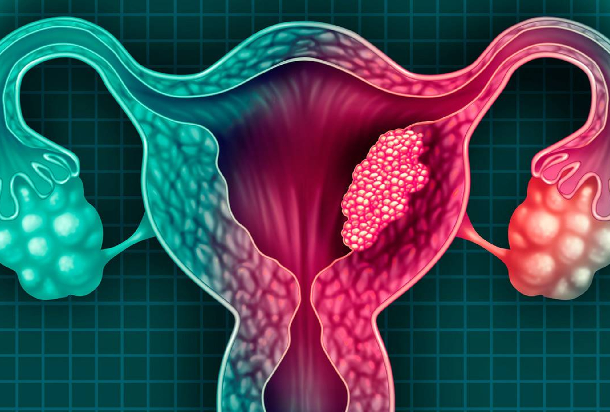 Cáncer del cuello uterino, única neoplasia prevenible al 100%: INCan