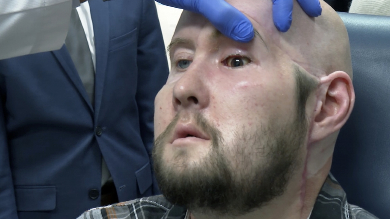 Realizan en EU primer trasplante de ojo en el mundo