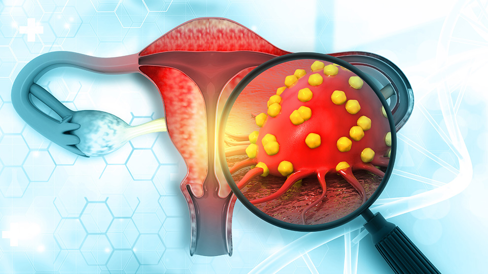 Importante, insistir en la prevención del cáncer cervicouterino