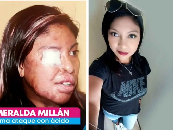 En Puebla mujer fue atacada con ácido por su expareja