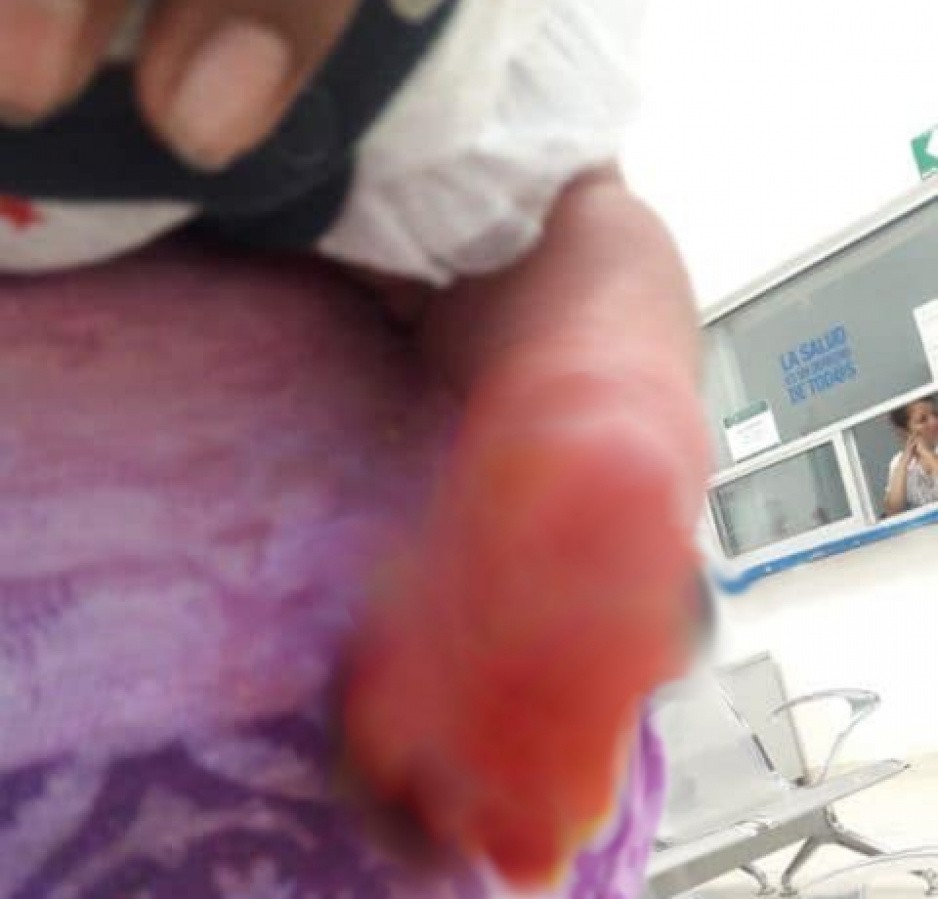 Bebé sufre quemaduras en centro de salud de Atencingo