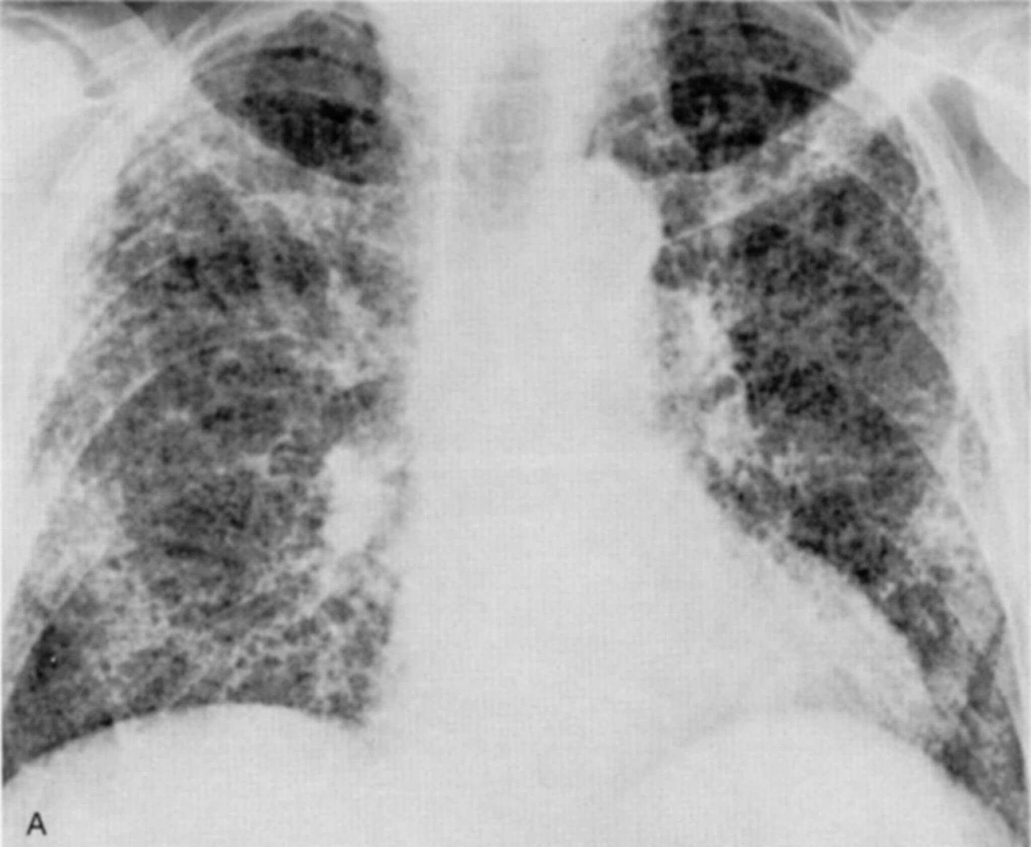 Fibrosis pulmonar afecta principalmente a hombres mayores de 50 años