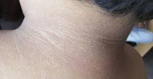 Ejercicio y dieta adecuada, remedio contra la acantosis pigmentaria