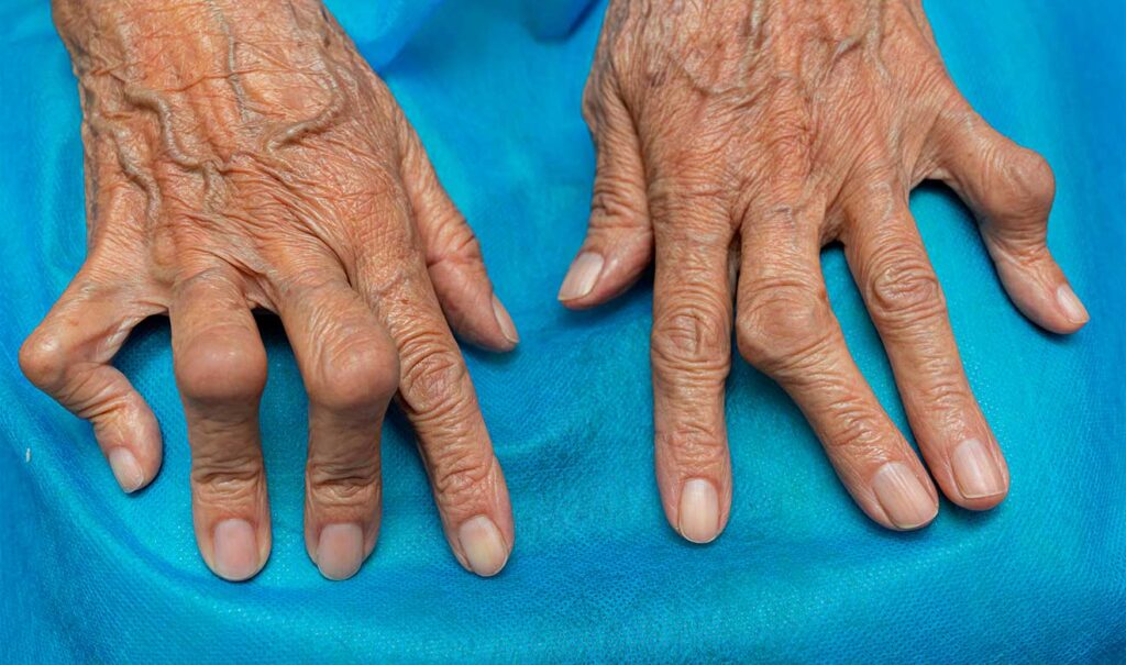 Cerca de 18 millones de personas en el mundo padecen artritis reumatoide