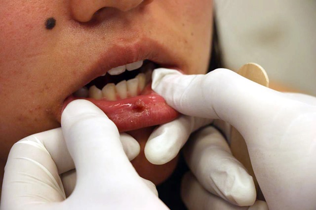BUAP controla y registra casos de cáncer oral