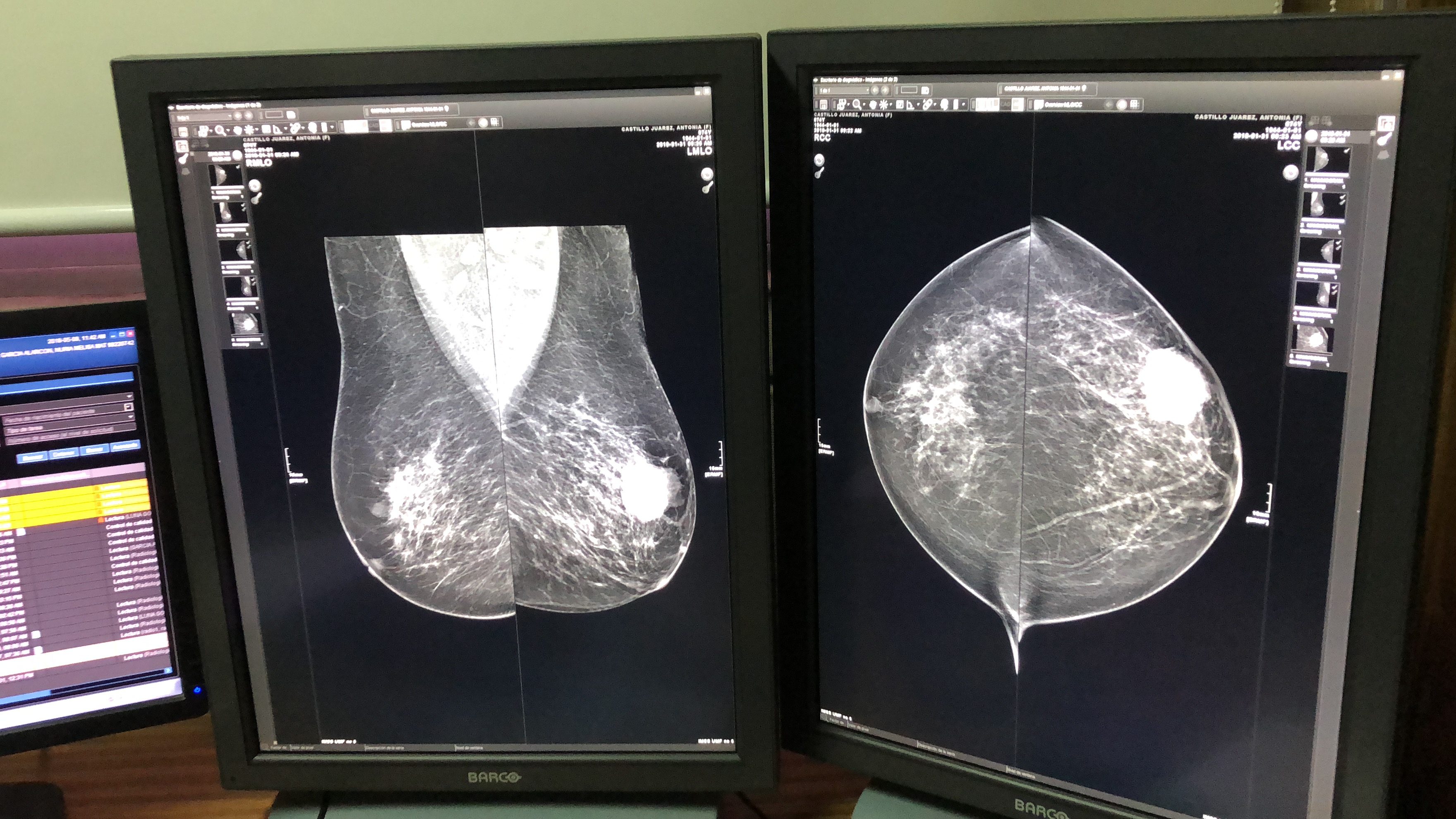 Sólo 10% de casos de cáncer de mama son hereditarios