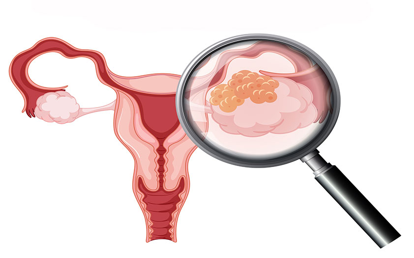Cáncer de ovario puede ser curable en 90% de casos detectados en etapa inicial: InCan