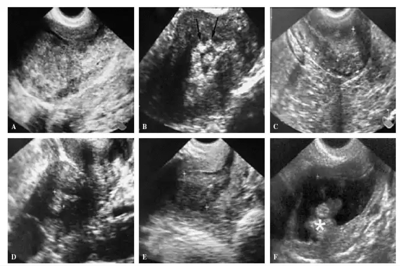 Cofepris avala medicamento para cáncer de endometrio hecho con ingeniería genética
