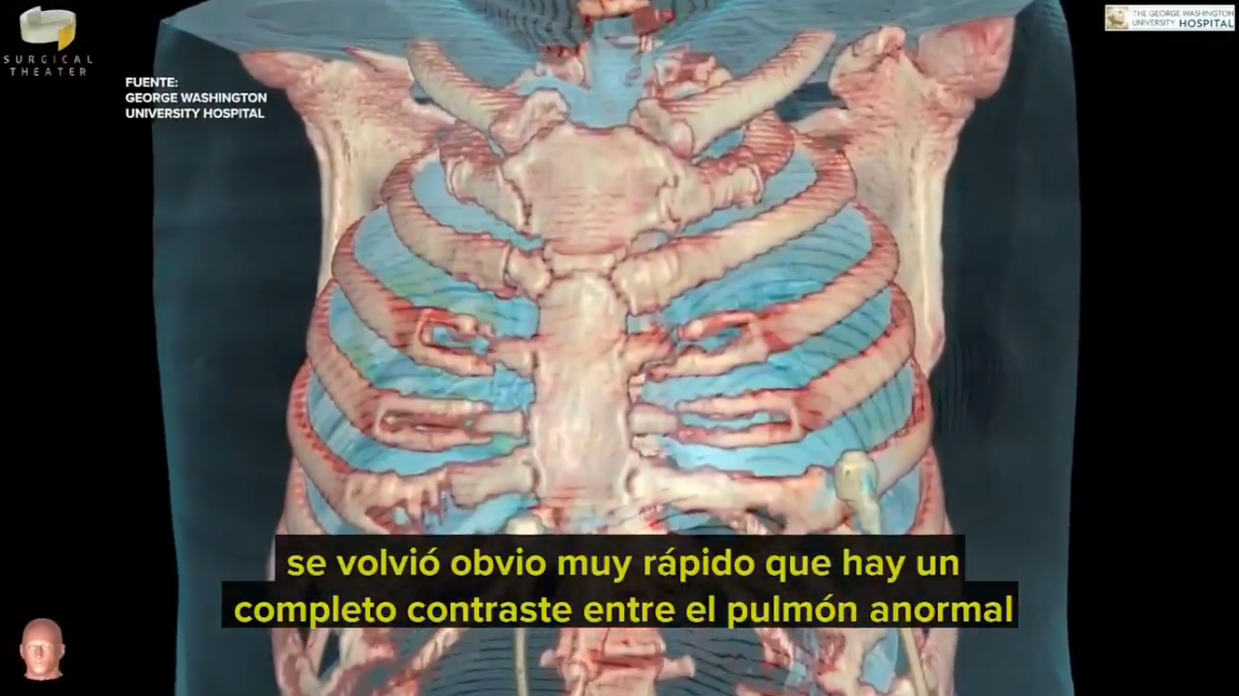 VIDEO Así afecta el coronavirus los pulmones de los pacientes