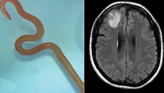 Extraen lombriz de 8 centímetros de cerebro de mujer australiana