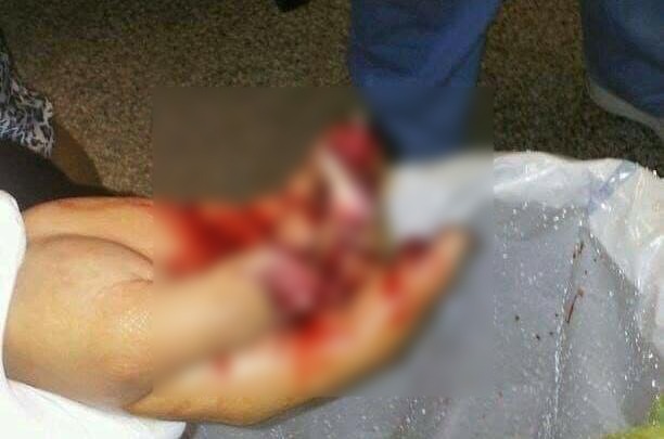 Le explota cuete en las manos, durante festejo en Tenampulco