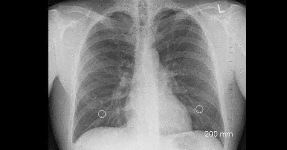 Fibrosis pulmonar afecta principalmente a personas mayores de 50 años