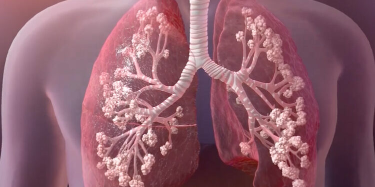 México, de los primeros países en avalar tratamiento para fibrosis quística