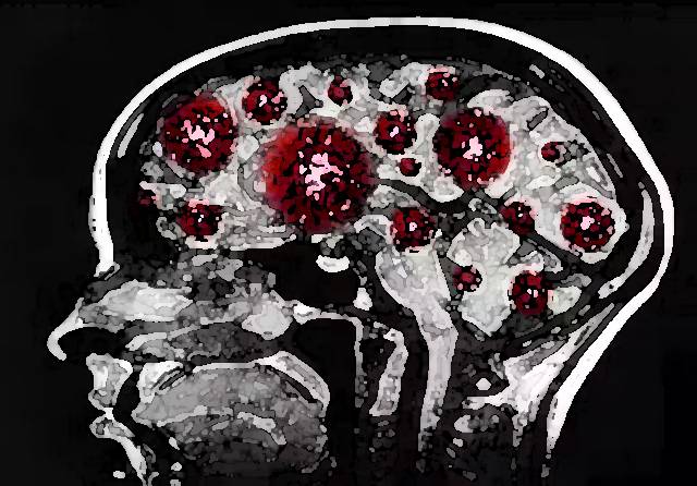 COVID grave causa envejecimiento cognitivo de 20 años