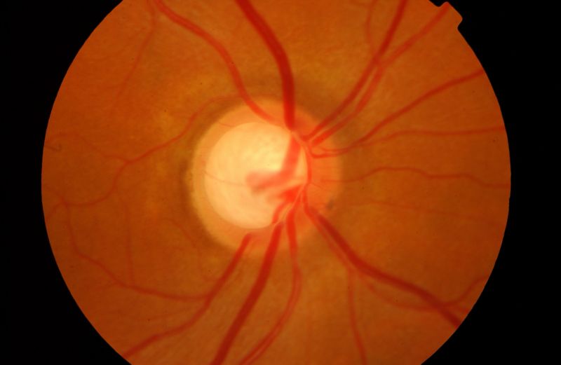 Hoy es Día mundial del glaucoma; entérate cómo es esta enfermedad