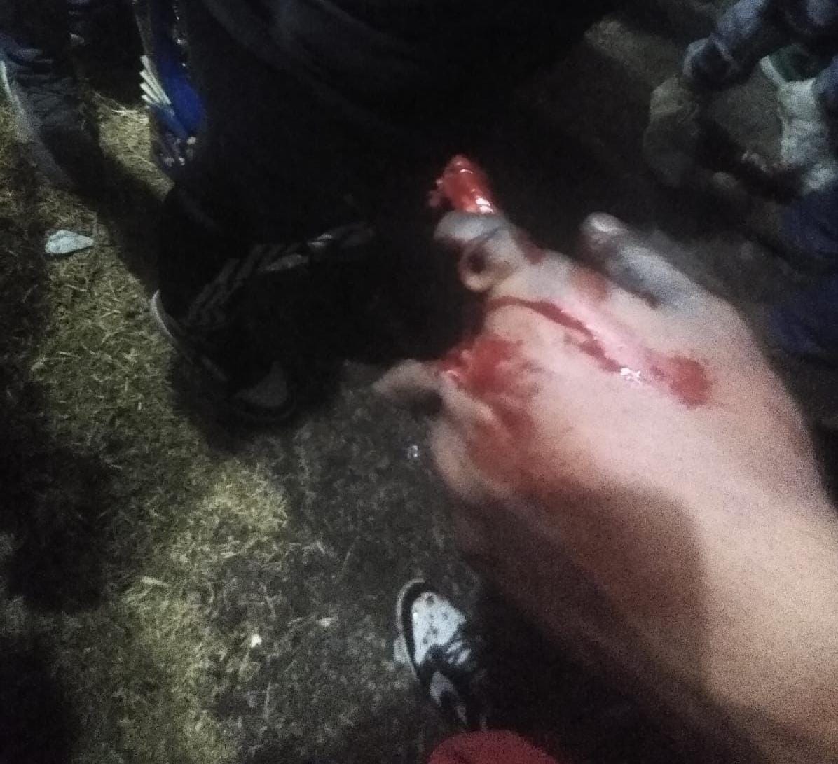 Previo al carnaval de Xalmimilulco, joven pierde varios dedos de la mano