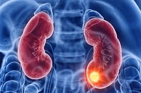 En México 60% de los casos de cáncer de riñón se detectan de forma incidental