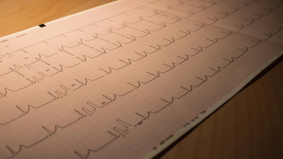 Identifican señales de infarto menos reconocidas por la población