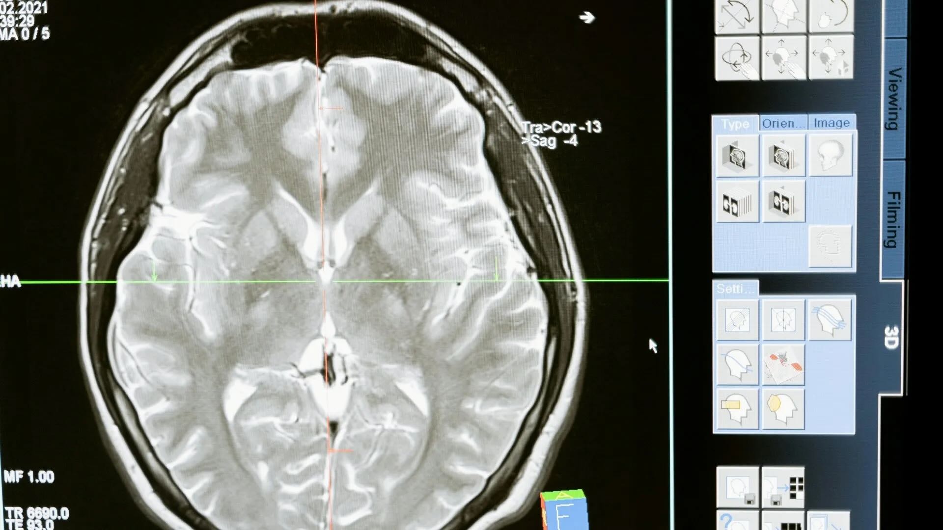 Pensó que era migraña, pero tenía larvas en el cerebro