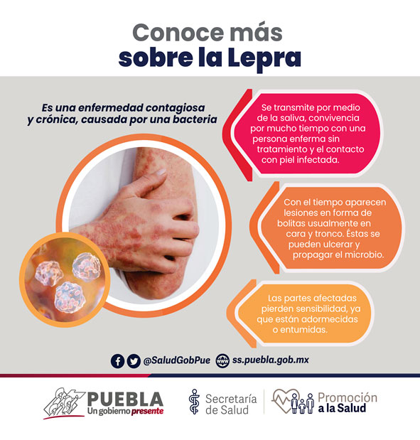 Detectan casos de lepra en la Mixteca poblana