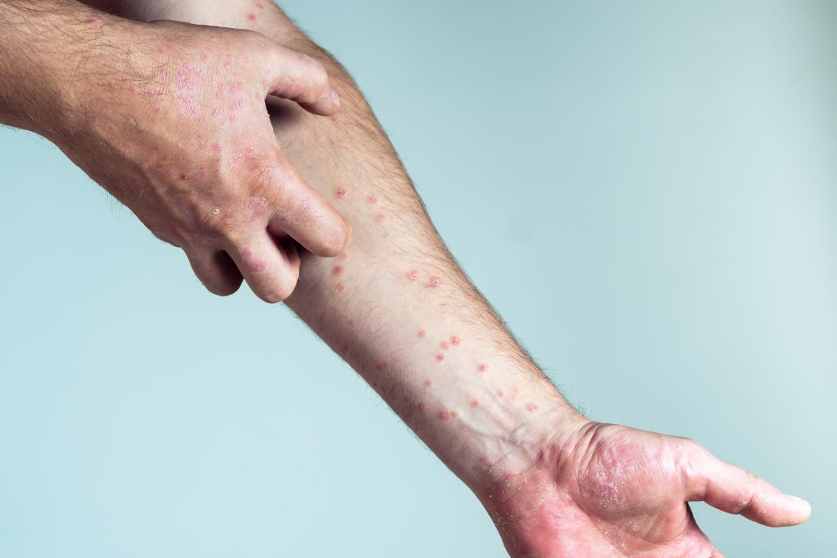 En México el 90% de las personas con lupus son mujeres en edad reproductiva
