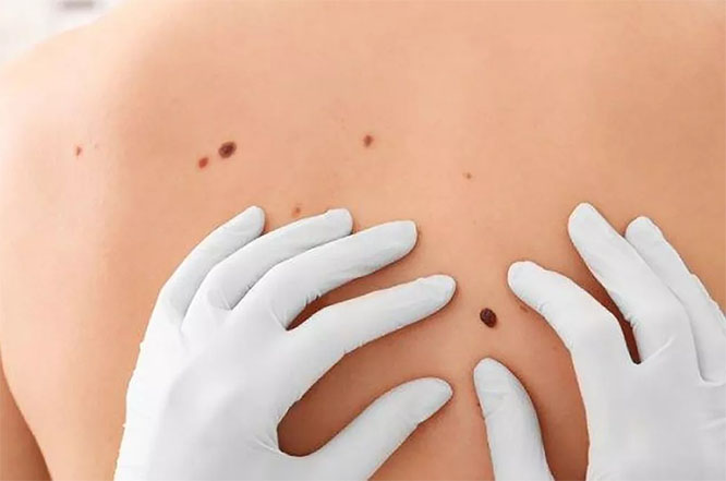 En el mundo se registran dos mil casos nuevos por año de melanoma