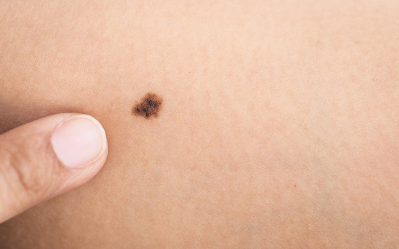 Cofepris avala ensayo clínico para vacuna innovadora contra melanoma