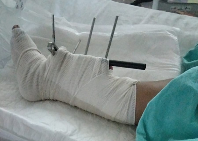 Papá de ex candidata atropella a menor y no se hace responsable de los gastos médicos