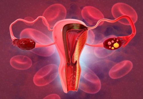 Síndrome de ovario poliquístico afecta al 22% de las mexicanas