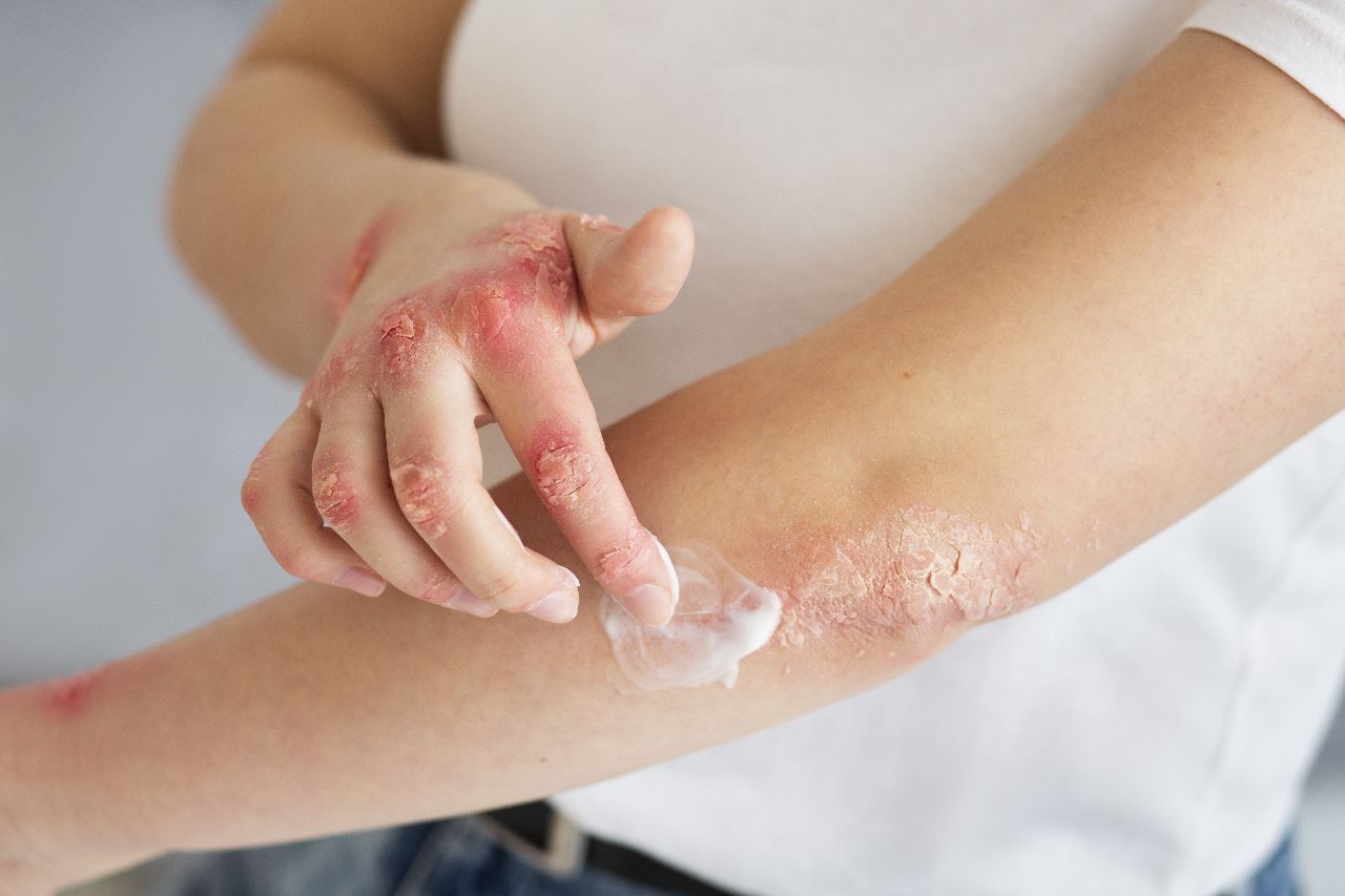 Psoriasis: enfermedad de la piel no contagiosa que puede controlarse con diagnóstico oportuno