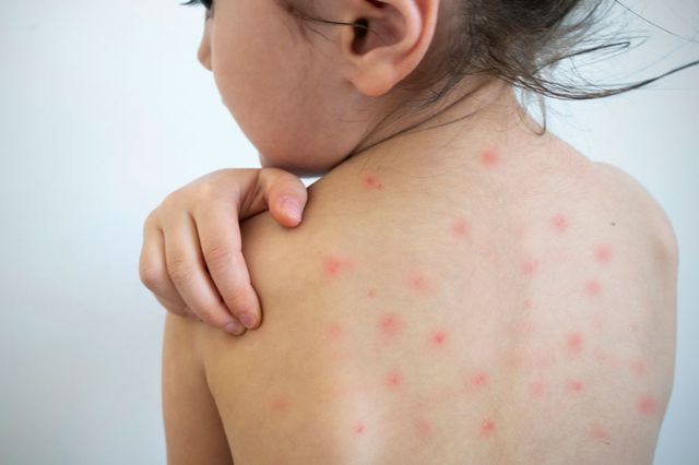 México reporta más de 4 mil casos de sarampión en 2025; OPS lanza alerta