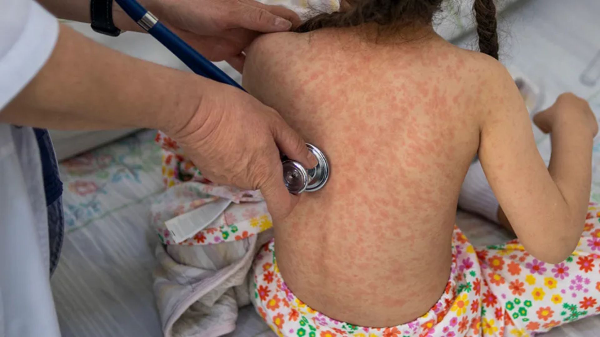 Se han registrado 2,942 casos de sarampión en México; 255 no se han comprobado