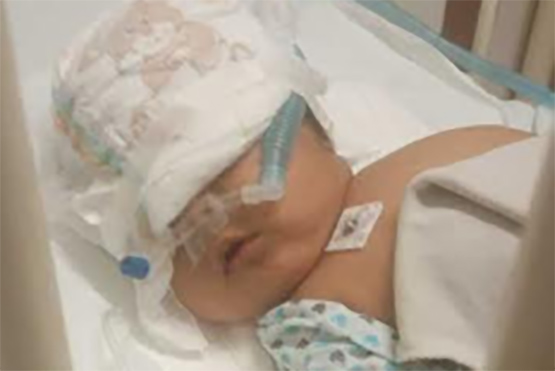 Piden apoyo para bebé hospitalizado por neumonía grave en Izúcar