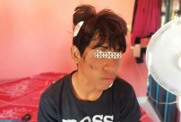 Policías de Tlapanalá atropellan a menor de 14 años