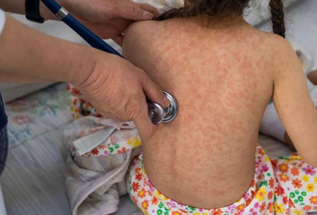 Se han registrado 2,942 casos de sarampión en México; 255 no se han comprobado