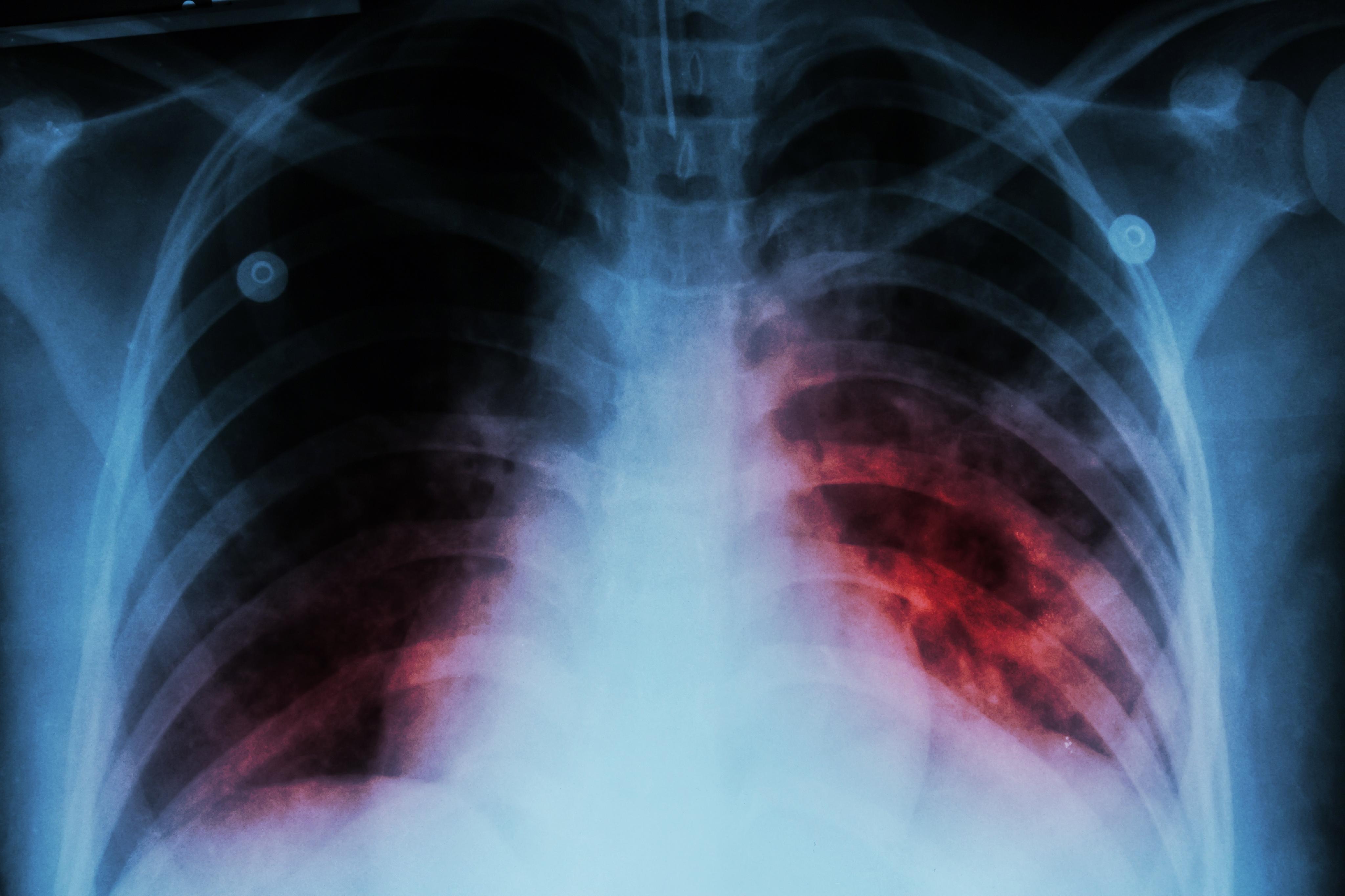 Tratamiento oportuno contra tuberculosis pulmonar cura la enfermedad: INER