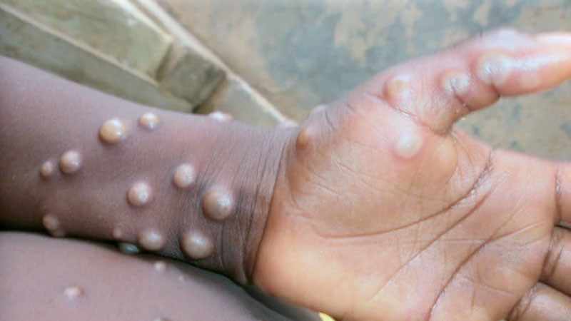 Alerta: Primeros dos casos de viruela del mono en Edomex