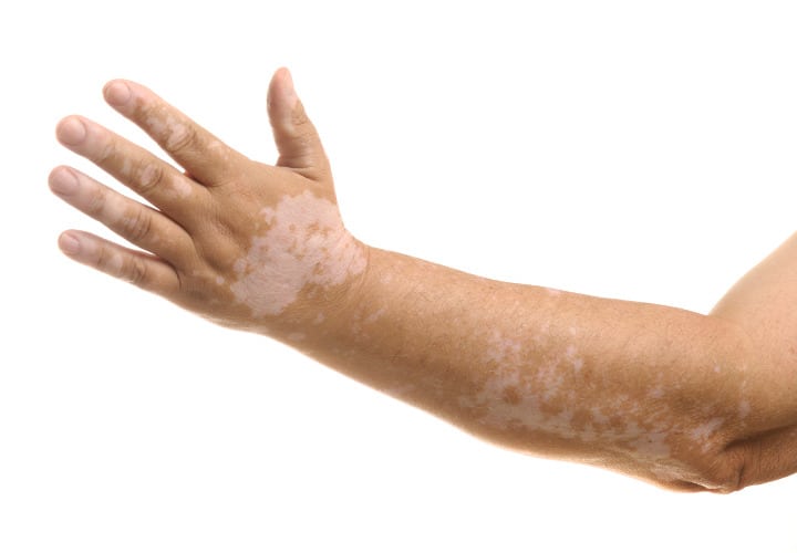 Se celebra hoy el Día Mundial del Vitiligo