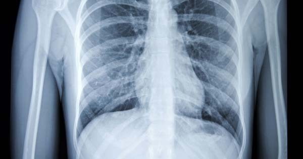 Sube demanda de placas de rayos X por para diagnosticar Covid en Tecamachalco